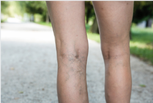 Adelaide varicose vein removal